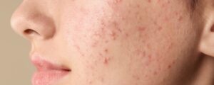 acne-1200x480