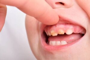 CARIES-CAPIRA-2
