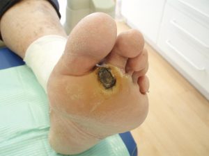pie-diabetico-1