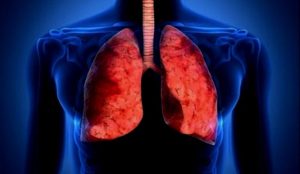 tuberculosis