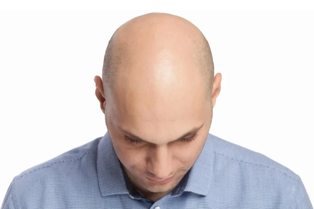 Implante-Capilar-Hair-Life-1536x1024
