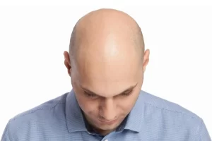 Implante-Capilar-Hair-Life-1536x1024