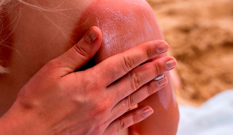view-young-girl-beach-with-lotion-sunburn-skin-768x445